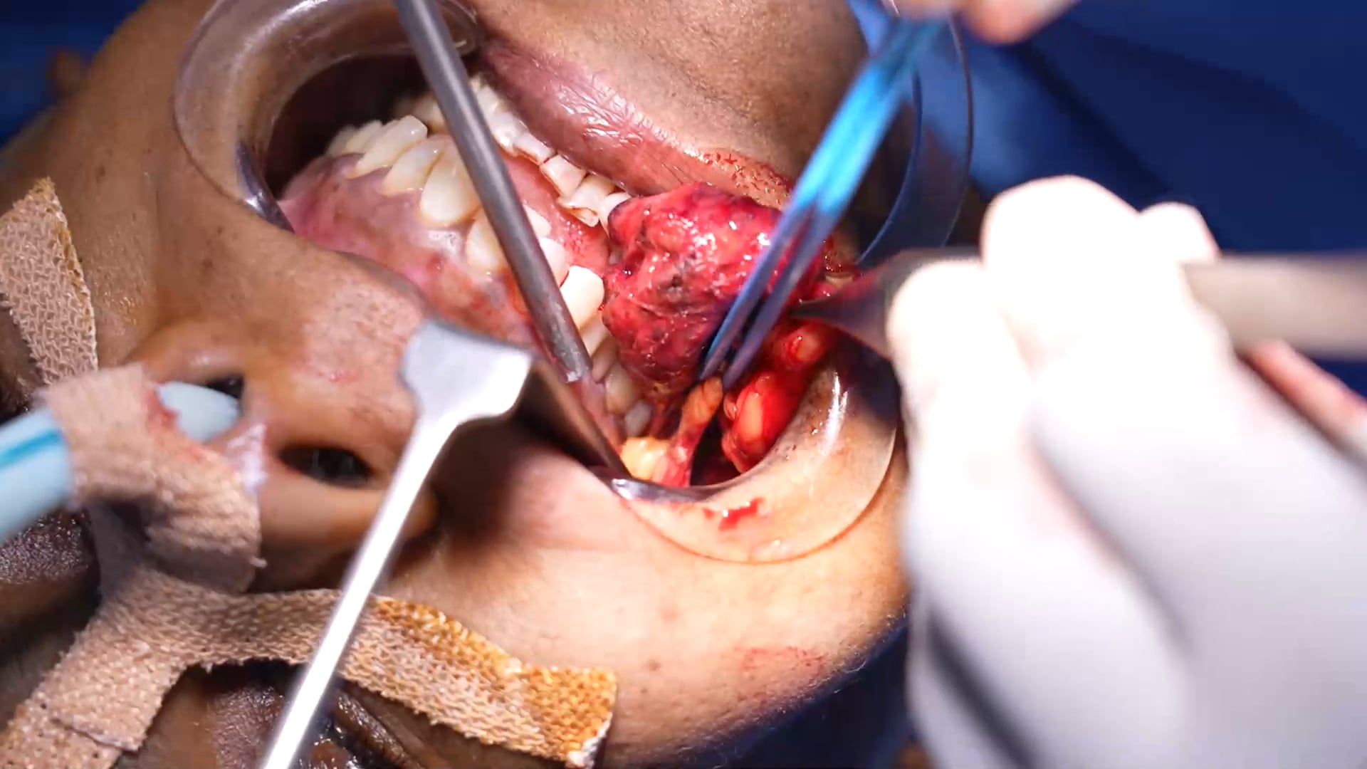 Hemangioma Tumor Removal